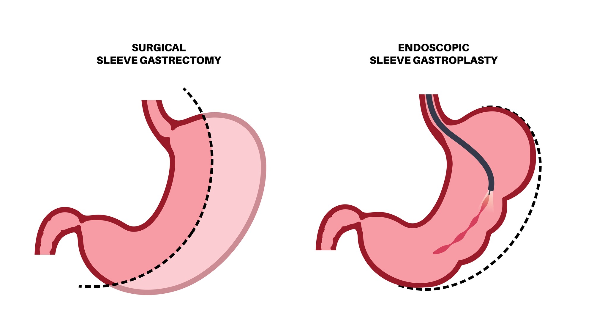 gastrectomy-and-gastroplasty