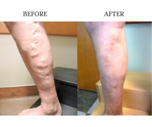 Before and after varicose vein treatment results at Beltline Health