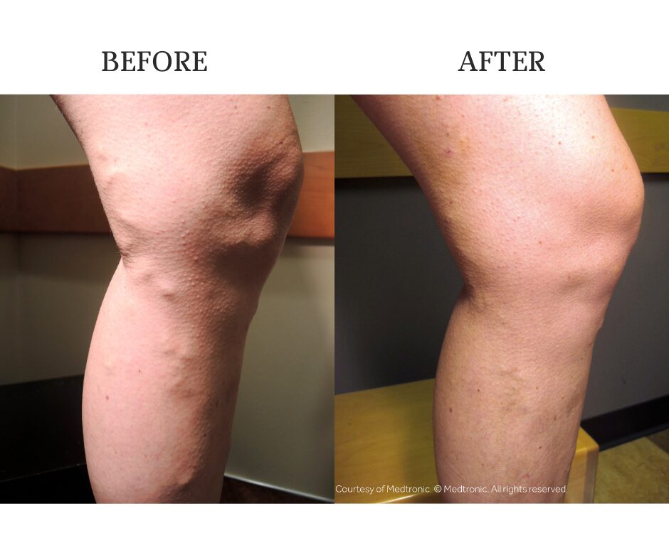 Before and after varicose vein treatment results