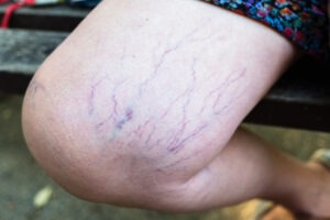 varicose veins on the leg of a woman