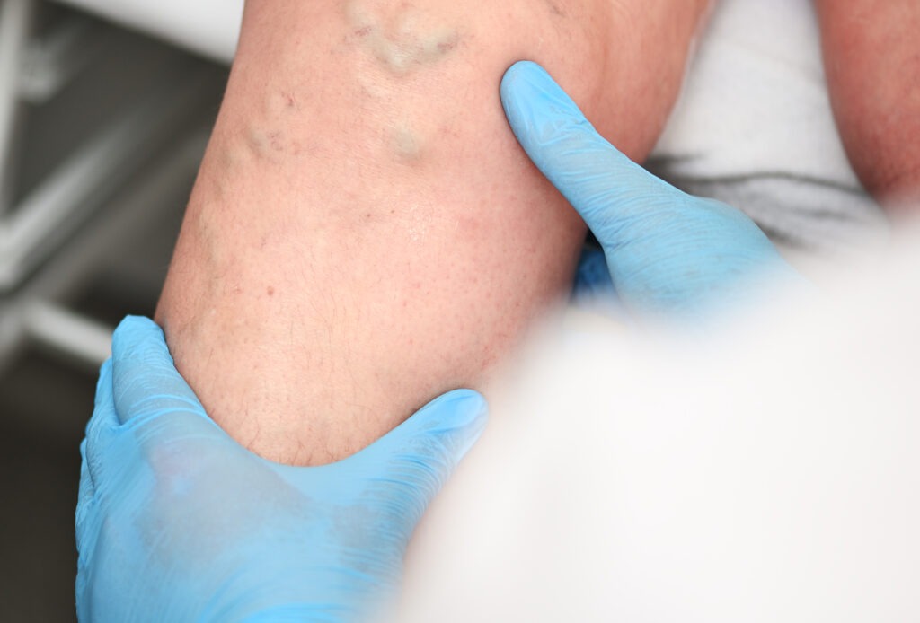 a phlebologist examines a patient with varicose veins on his leg. phlebology - study of venous pathologies of the lower extremities