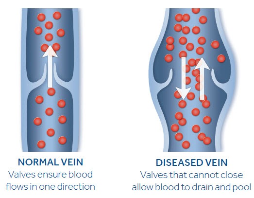 Normal Vein vs. Diseased Vein