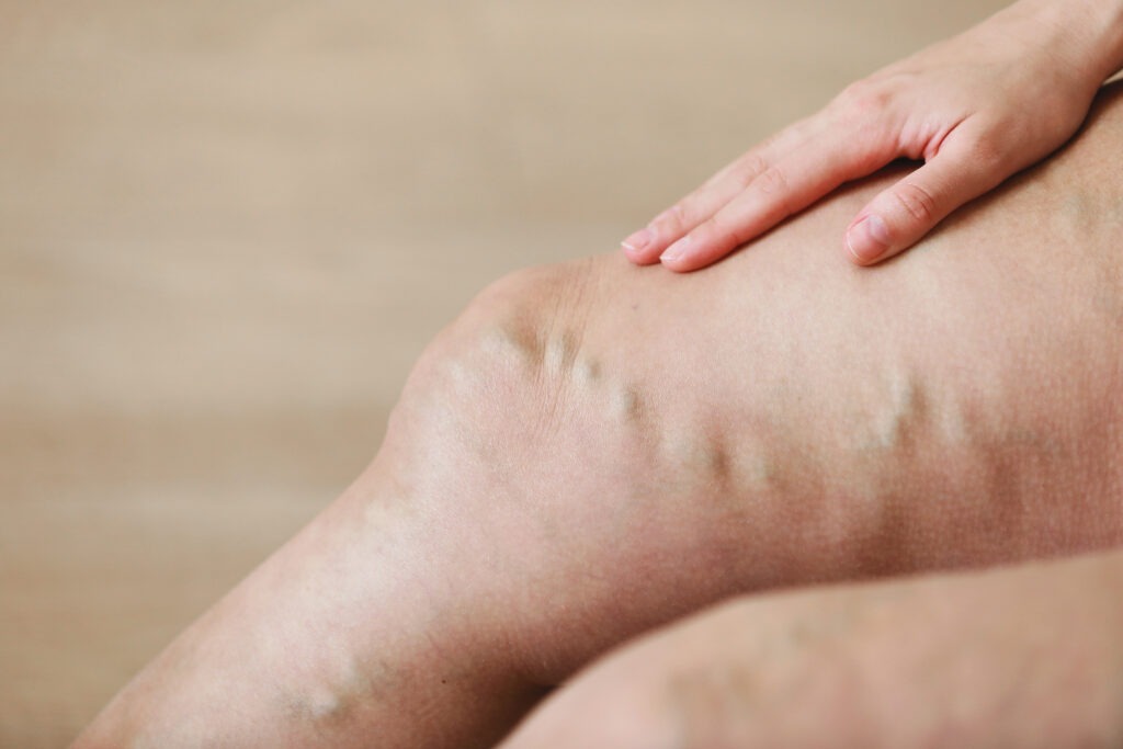 Painful varicose and spider veins on active womans legs, self-helping herself in overcoming the pain. Vascular disease, varicose veins problems, active life concept