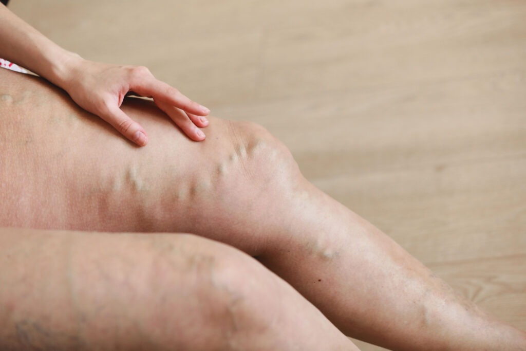 Painful varicose and spider veins on active womans legs, self-helping herself in overcoming the pain. Vascular disease, varicose veins problems, active life concept