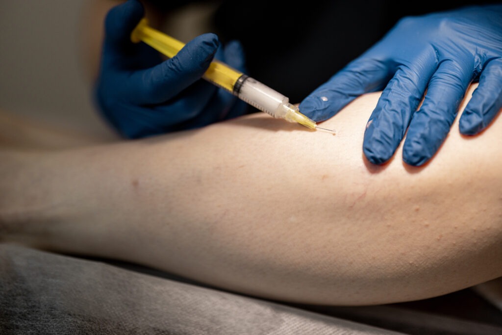 Phlebologist makes injections into a vein, performing sclerotherapy on the veins of women's leg, close-up. Concept of medical treatment of varicose veins